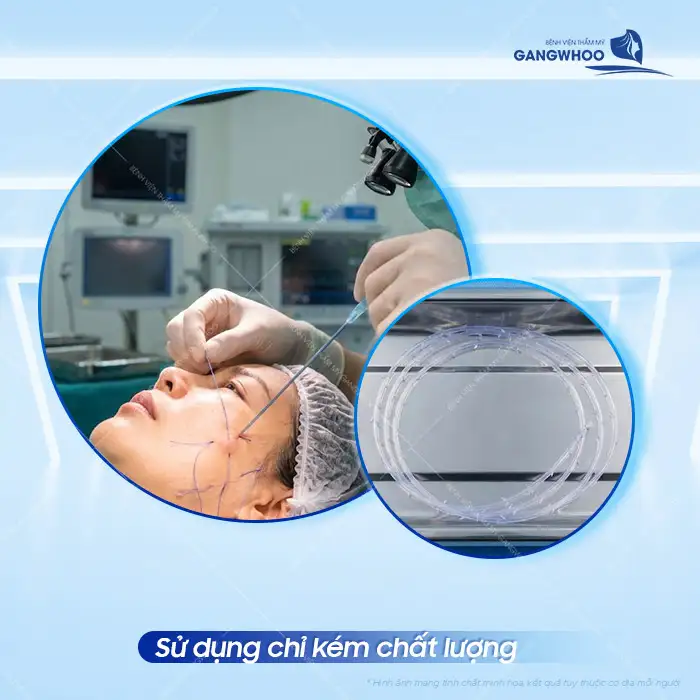 Nguyên nhân căng da mặt bằng chỉ bị lồi lõm và cách khắc phục hiệu quả