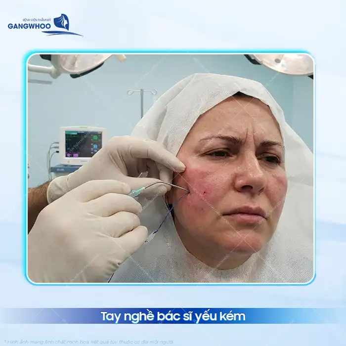 Nguyên nhân căng da mặt bằng chỉ bị lồi lõm và cách khắc phục hiệu quả