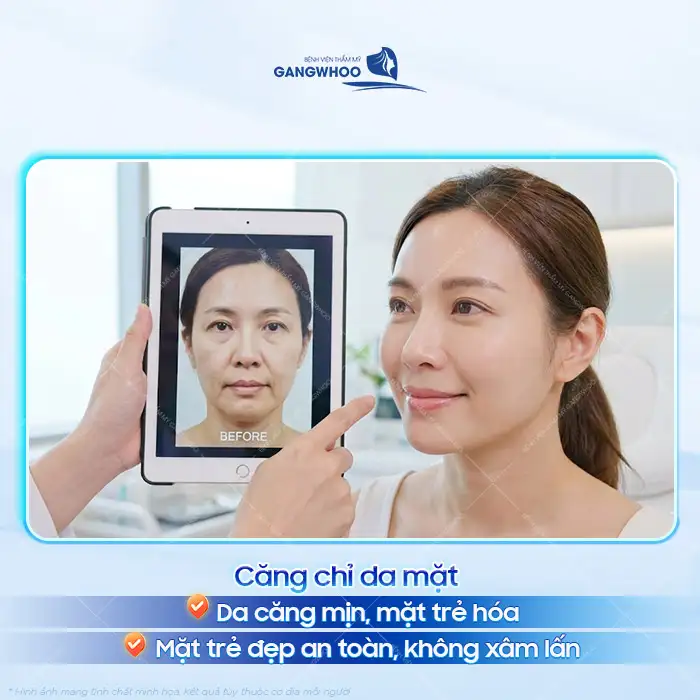 Căng chỉ da mặt giá bao nhiêu? Cập nhật bảng giá căng chỉ da mặt 2025