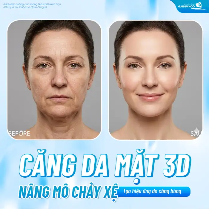 Căng da mặt 3D là gì? Phương pháp căng da mặt 3D có an toàn không?