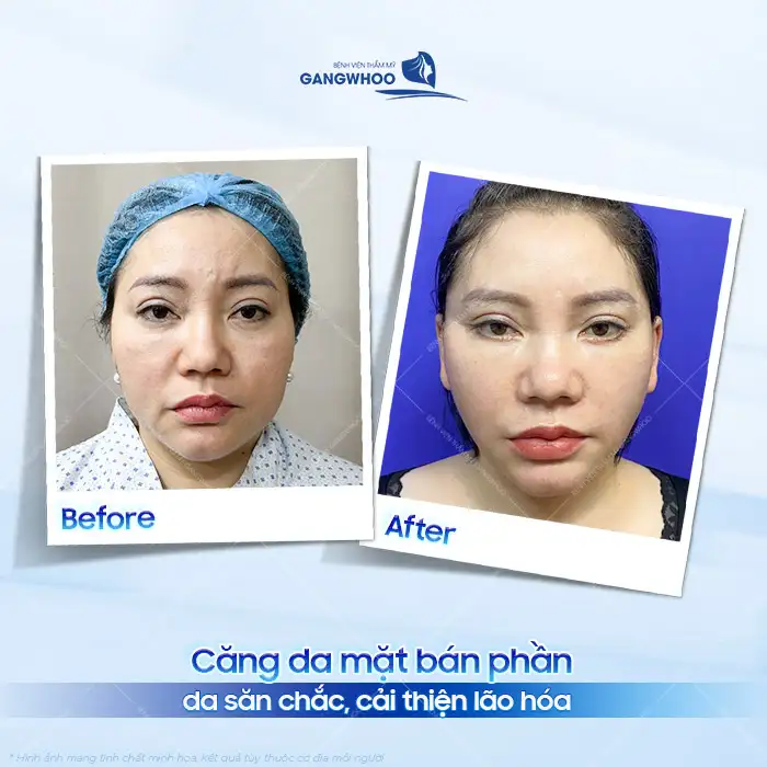 Căng da mặt bán phần là gì? Ưu, nhược điểm của căng da mặt bán phần