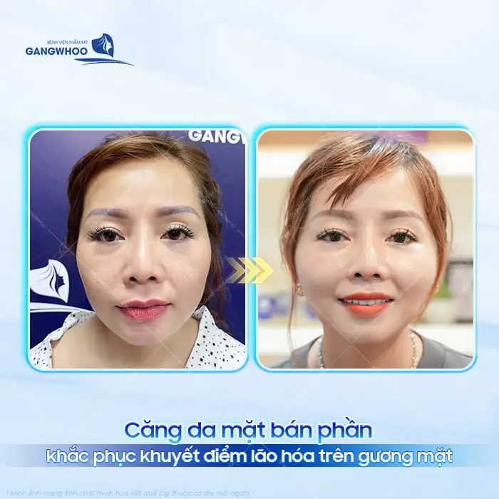 Căng da mặt bán phần là gì? Ưu, nhược điểm của căng da mặt bán phần