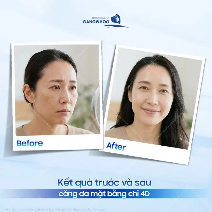 Căng da mặt bằng chỉ 4d là gì? Ưu, nhược điểm của phương pháp