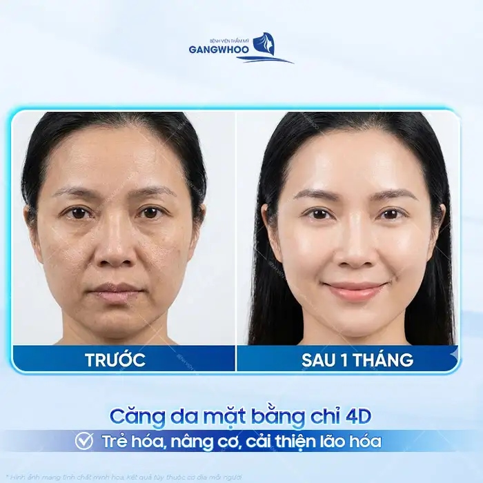 Căng da mặt bằng chỉ 4d là gì? Ưu, nhược điểm của phương pháp