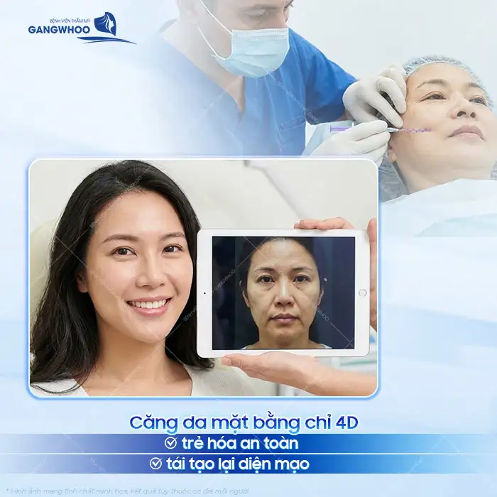 Căng da mặt bằng chỉ 4d là gì? Ưu, nhược điểm của phương pháp