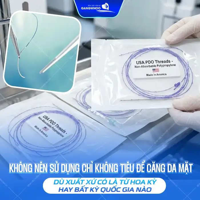 Có nên căng da mặt bằng chỉ không tiêu Hoa Kỳ? Có gây biến chứng Không?