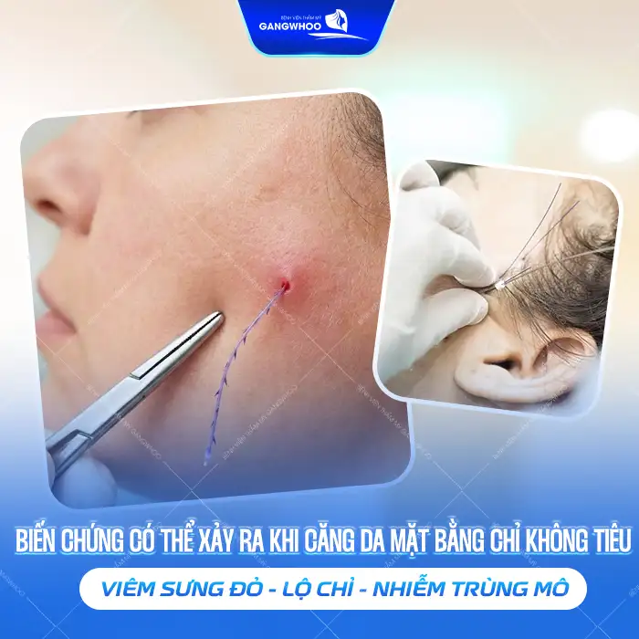 Có nên căng da mặt bằng chỉ không tiêu Hoa Kỳ? Có gây biến chứng Không?