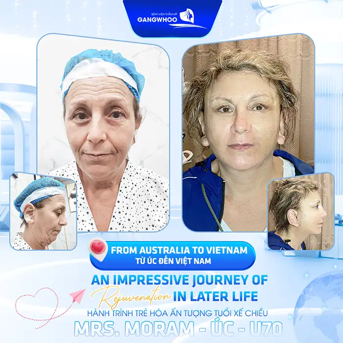 Căng da mặt bằng chỉ kim cương là gì? Có an toàn và hiệu quả không?