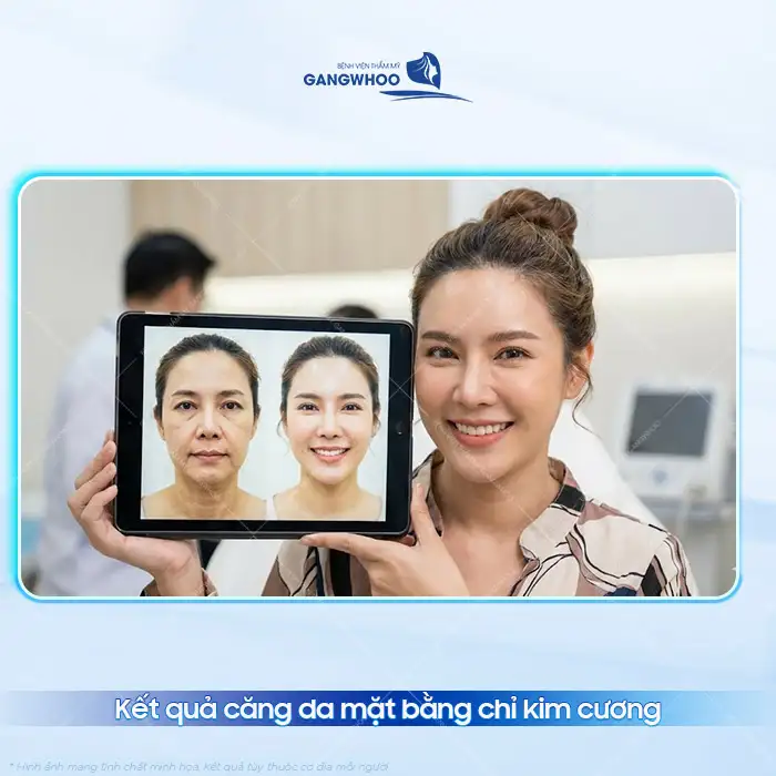 Căng da mặt bằng chỉ kim cương là gì? Có an toàn và hiệu quả không?