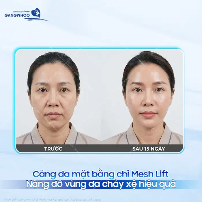 Căng da mặt bằng chỉ Mesh Lift là gì? Ưu, nhược điểm của chỉ Mesh Lift