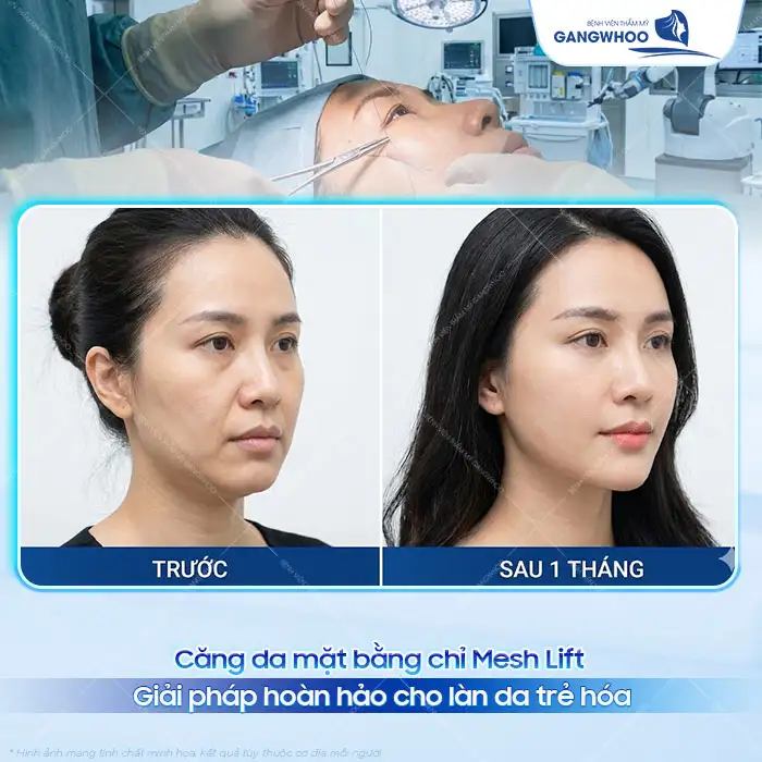 Căng da mặt bằng chỉ Mesh Lift là gì? Ưu, nhược điểm của chỉ Mesh Lift
