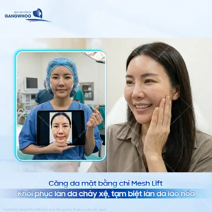 Căng da mặt bằng chỉ Mesh Lift là gì? Ưu, nhược điểm của chỉ Mesh Lift