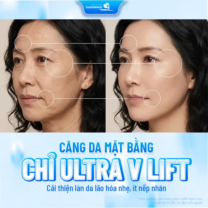 Căng da mặt bằng chỉ Ultra V Lift là gì? Có mang lại hiệu quả không?