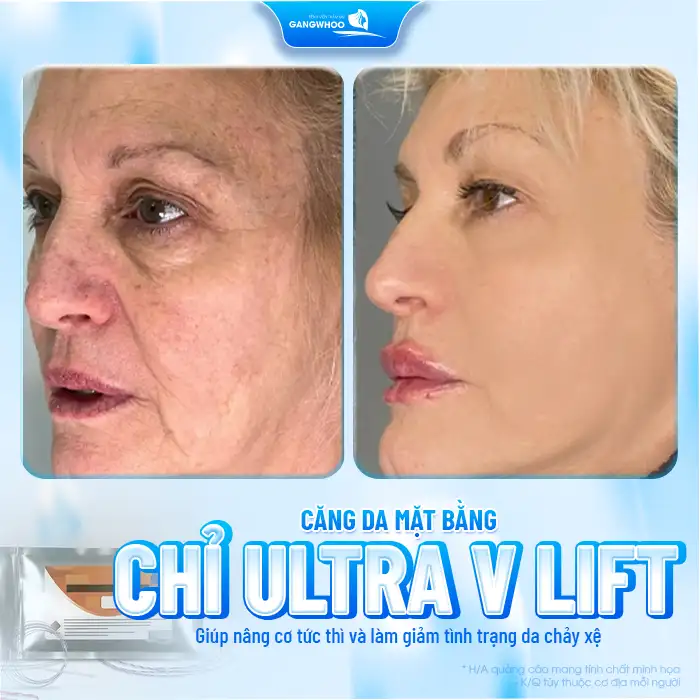 Căng da mặt bằng chỉ Ultra V Lift là gì? Có mang lại hiệu quả không?