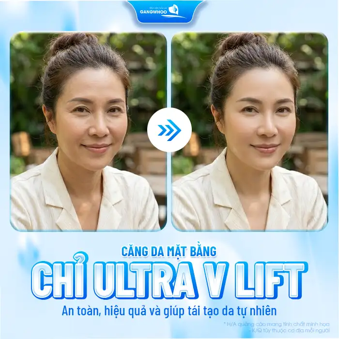 Căng da mặt bằng chỉ Ultra V Lift là gì? Có mang lại hiệu quả không?