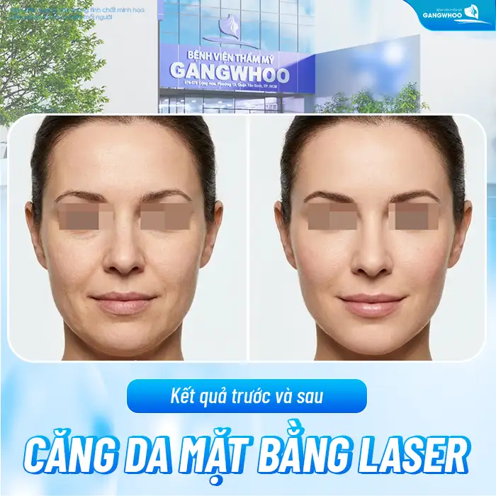 Căng da mặt bằng Laser là gì? Ưu, nhược điểm khi căng da mặt bằng Laser
