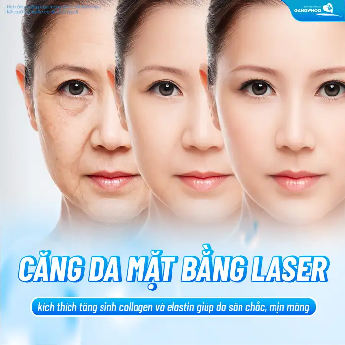 Căng da mặt bằng Laser là gì? Ưu, nhược điểm khi căng da mặt bằng Laser
