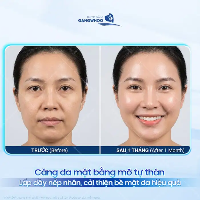 Phương pháp căng da mặt bằng mỡ tự thân là gì? Có an toàn không?