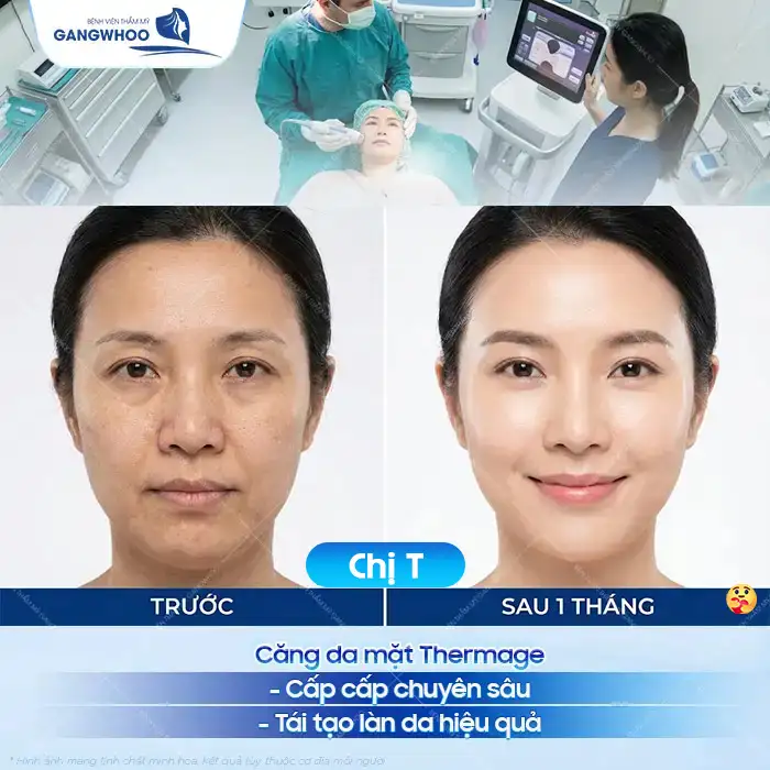 Căng da mặt Thermage được bao lâu? Cách để duy trì hiệu quả lâu dài