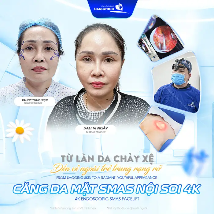 Căng da mặt có đau không? Những yếu tố gây đau sai khi căng da mặt