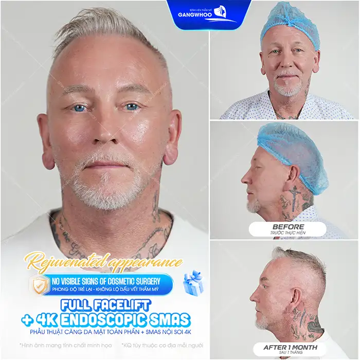 Căng da mặt có đau không? Những yếu tố gây đau sai khi căng da mặt