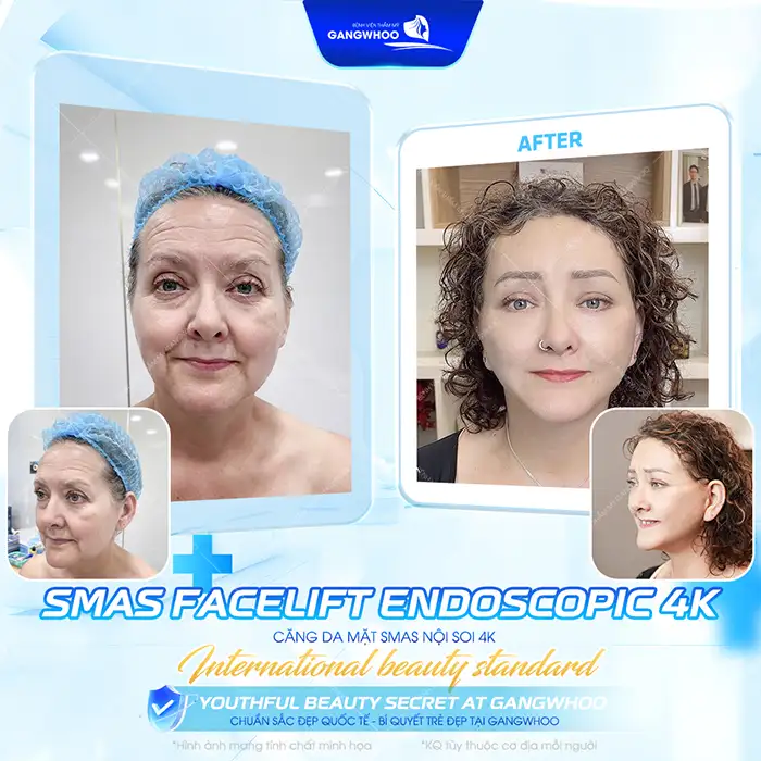 Căng da mặt có đau không? Những yếu tố gây đau sai khi căng da mặt