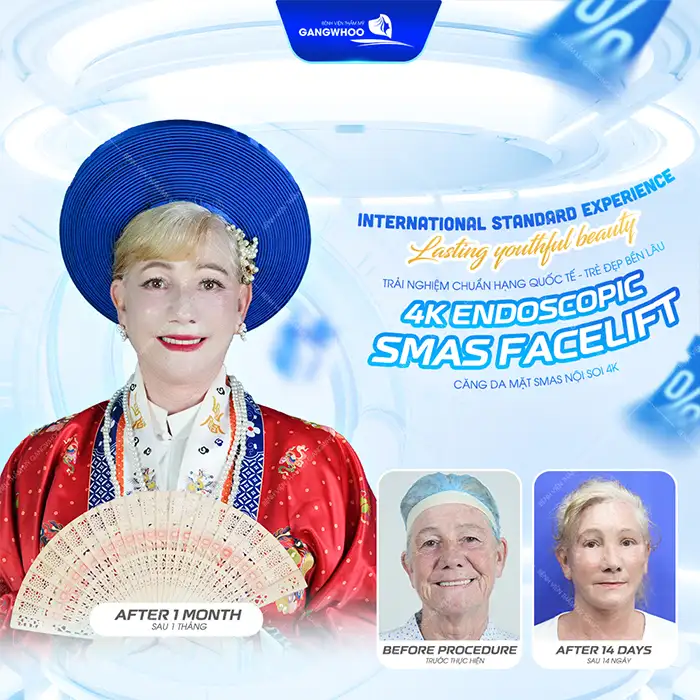 Căng da mặt giá bao nhiêu tiền? Cập nhật bảng giá mới nhất 2026