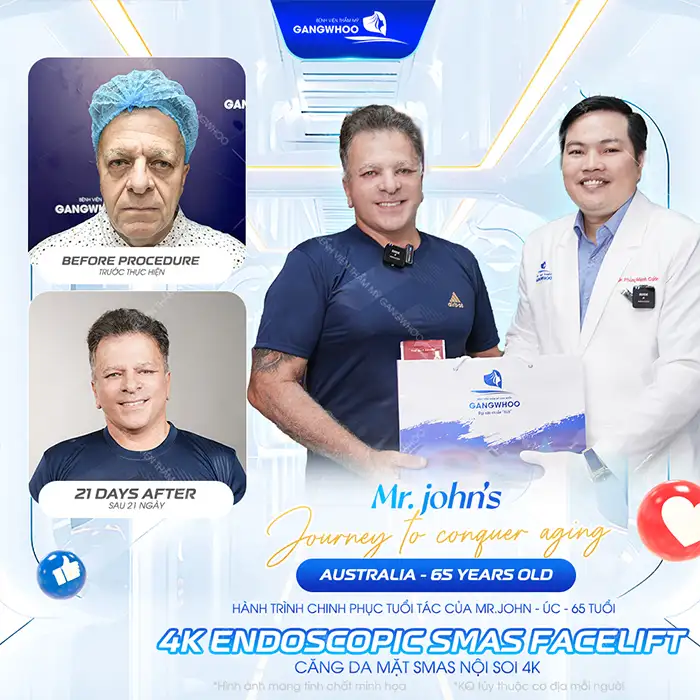 Căng da mặt giá bao nhiêu tiền? Cập nhật bảng giá mới nhất 2026