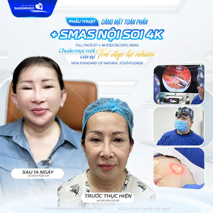 Căng da mặt giá bao nhiêu tiền? Cập nhật bảng giá mới nhất 2026