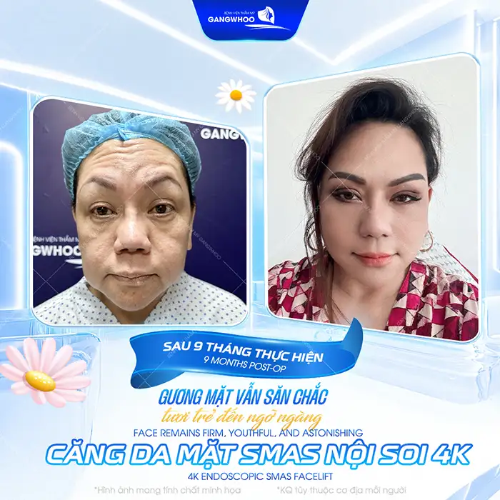 Các phương pháp căng da mặt không cần phẫu thuật phổ biến hiện nay?