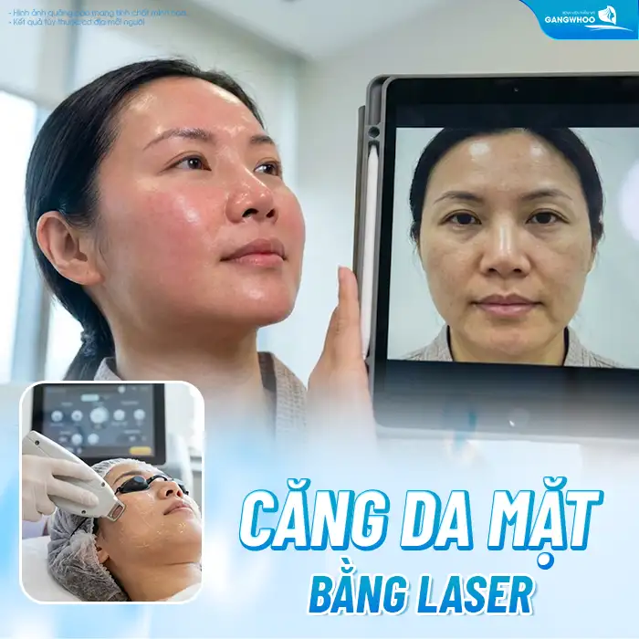 Các phương pháp căng da mặt không cần phẫu thuật phổ biến hiện nay?