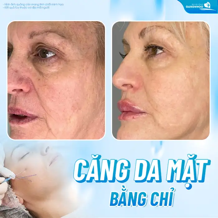 Các phương pháp căng da mặt không cần phẫu thuật phổ biến hiện nay?