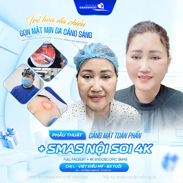 Căng da mặt nội soi giá bao nhiêu? Cập nhật bảng giá mới nhất 2026