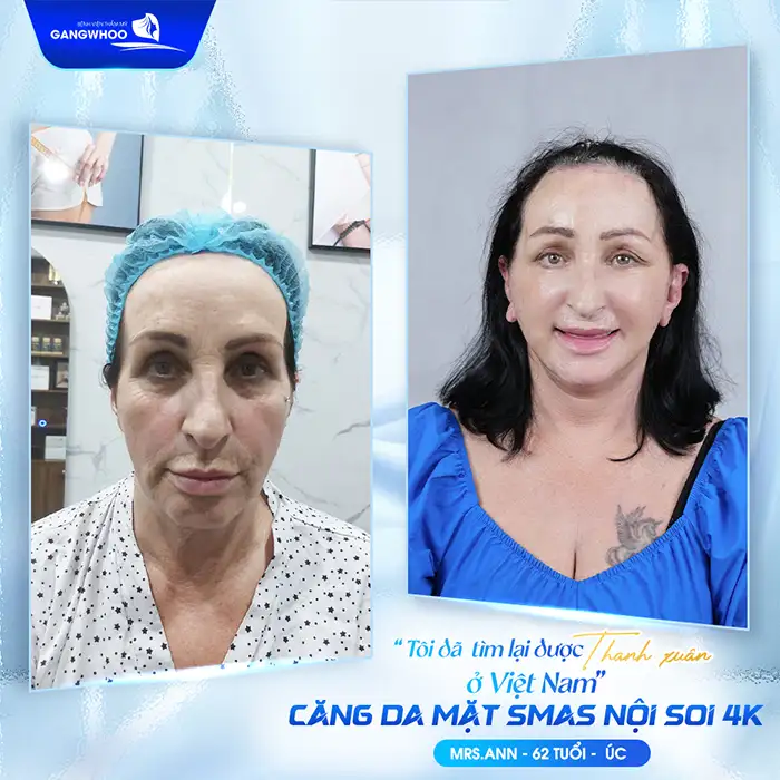 Căng da mặt ở đâu tốt? Tham khảo 7+ địa chỉ căng da mặt uy tín