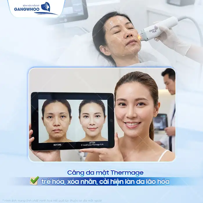 Căng da mặt Thermage được bao lâu? Cách để duy trì hiệu quả lâu dài