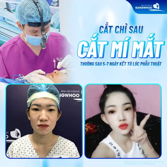 Cách cắt chỉ mí mắt chuẩn y khoa ra sao? Cách chăm sóc sau khi cắt chỉ