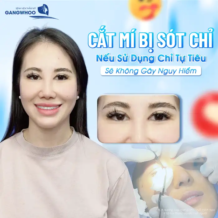 Cắt chỉ mí mắt bị sót có sao không? Cách xử lý như thế nào?