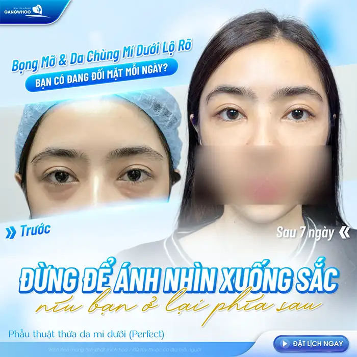 Cắt da thừa mí mắt dưới bao nhiêu tiền? Cập nhật bảng giá cắt mí mới nhất 2025