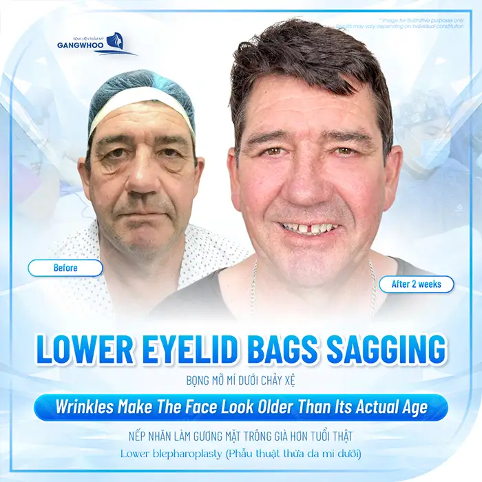 Cắt da thừa mí mắt dưới bao nhiêu tiền? Cập nhật bảng giá cắt mí mới nhất 2025