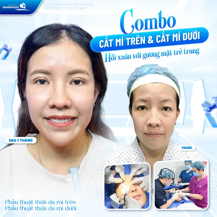 Cắt da thừa mí mắt dưới bao nhiêu tiền? Cập nhật bảng giá cắt mí mới nhất 2025