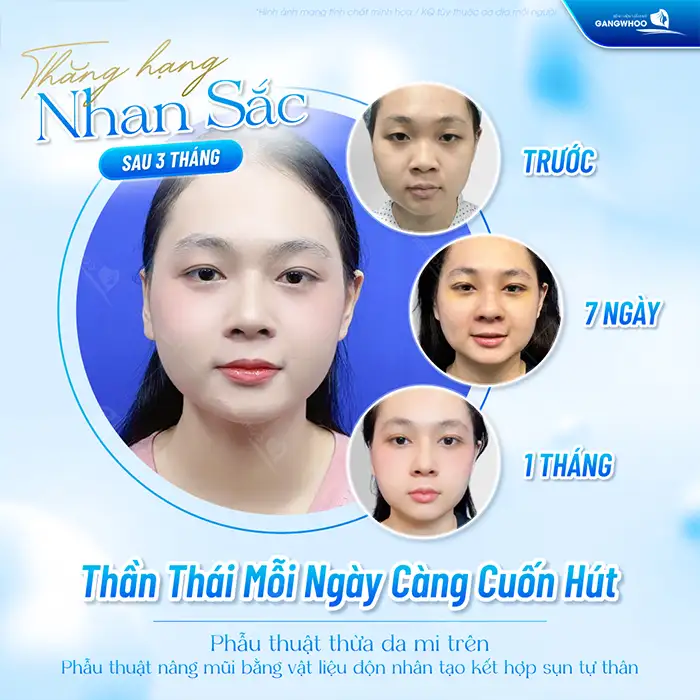 Giá cắt mí plasma bao nhiêu tiền? Cập nhật bảng giá cắt mí plasma mới nhất 2025