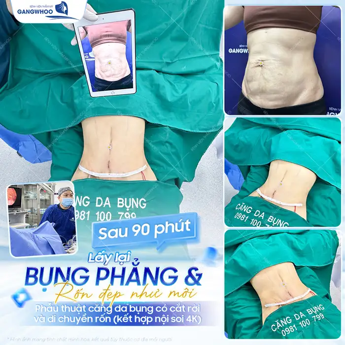 Cắt hay hút mỡ bụng tốt hơn? Phương pháp nào hiệu quả nhất