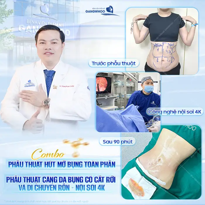 Cắt hay hút mỡ bụng tốt hơn? Phương pháp nào hiệu quả nhất