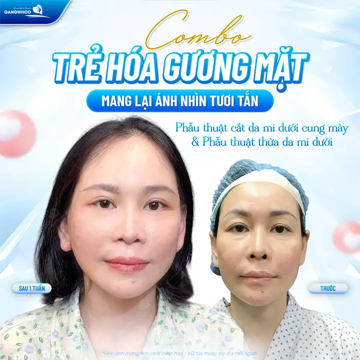 Cắt mắt sụp mí bao nhiêu tiền? Cập nhật bảng giá cắt mí mới nhất 2025