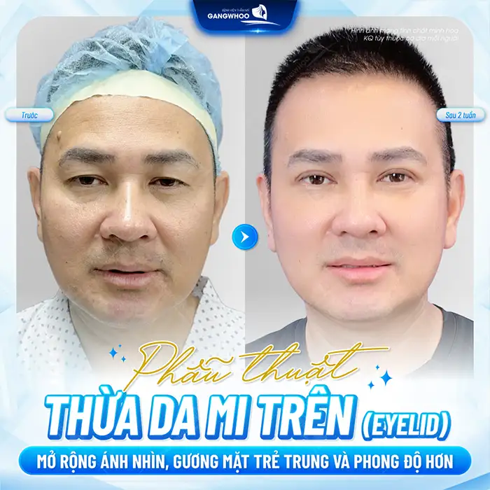 Cắt mắt sụp mí bao nhiêu tiền? Cập nhật bảng giá cắt mí mới nhất 2025