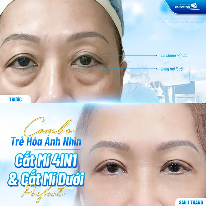 Cắt mắt sụp mí bao nhiêu tiền? Cập nhật bảng giá cắt mí mới nhất 2025