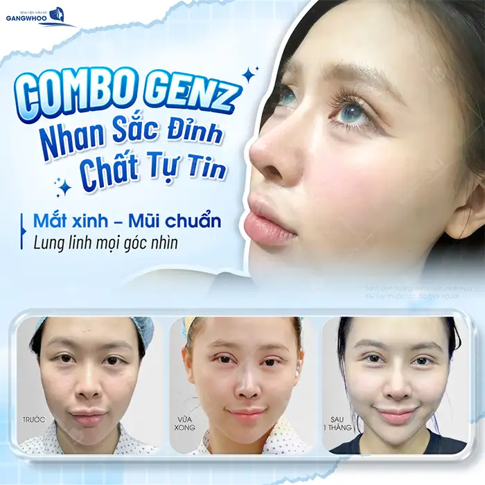 Cắt mí mắt Ấn Độ là gì? Những ai phù hợp để cắt mí Ấn Độ