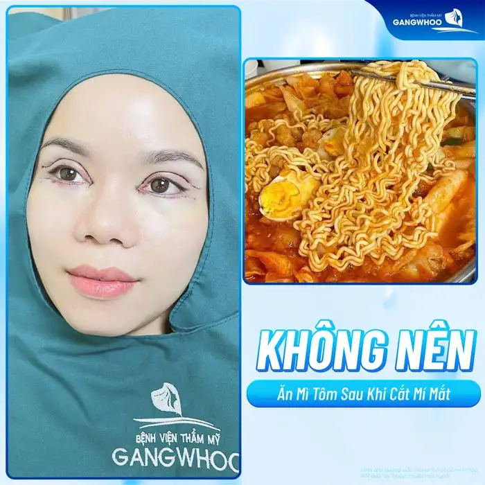 Sau cắt mí ăn mì tôm được không? Nên kiêng ăn mì tôm bao lâu?