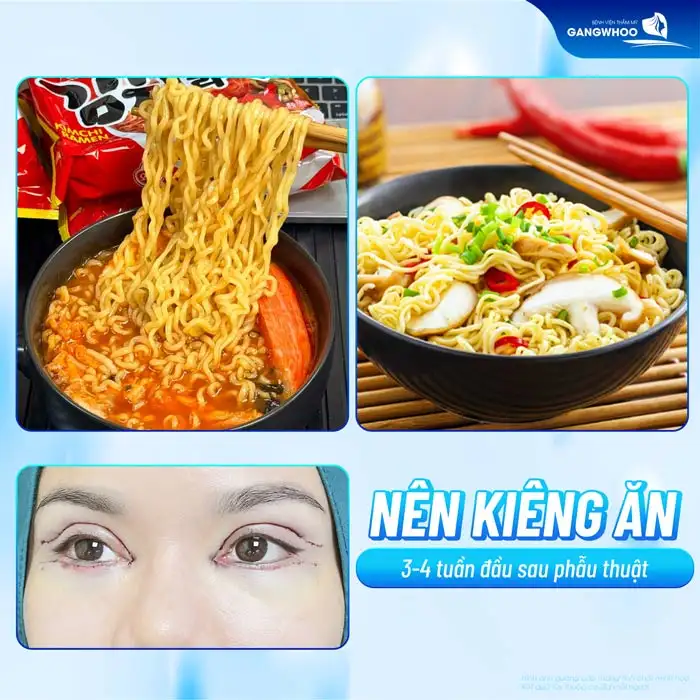 Sau cắt mí ăn mì tôm được không? Nên kiêng ăn mì tôm bao lâu?