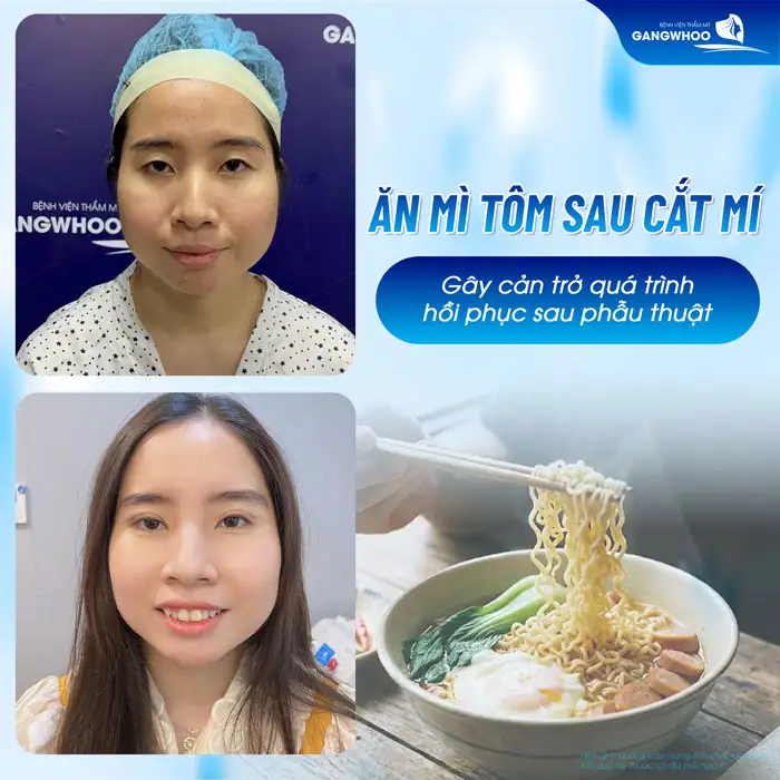 Sau cắt mí ăn mì tôm được không? Nên kiêng ăn mì tôm bao lâu?
